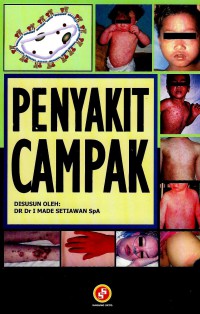 Image of Penyakit Campak