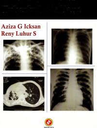 Image of Radiologi Toraks Tuberkulosis Paru