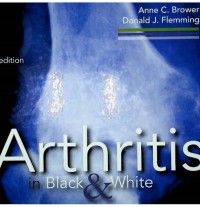 Image of Arthritis in Black and White