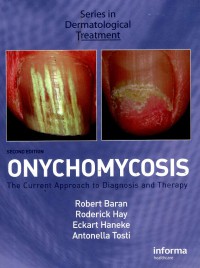 Image of Onychomicosis: The Current approach to diagnosis and therapy
