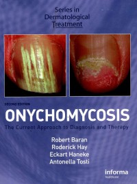 Onychomicosis: The Current approach to diagnosis and therapy